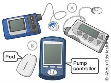 What People Are Not Good Candidates For An Insulin Pump